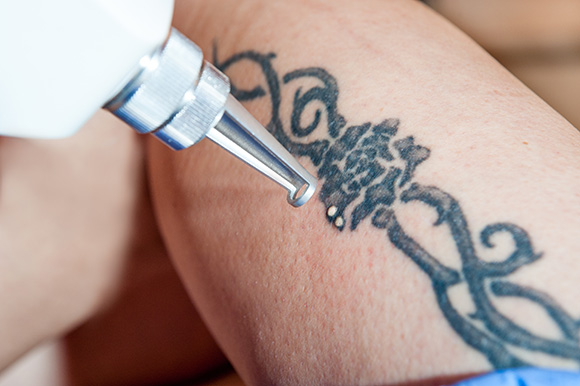 Laserentfernungen von Tätowierungen Orthopädie Hickmann
